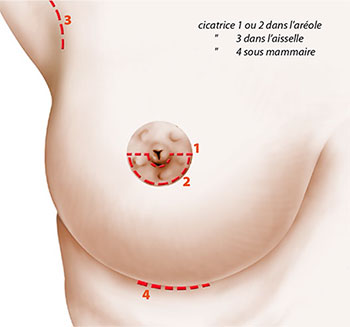 chirurgie augmentation mammaire montpellier