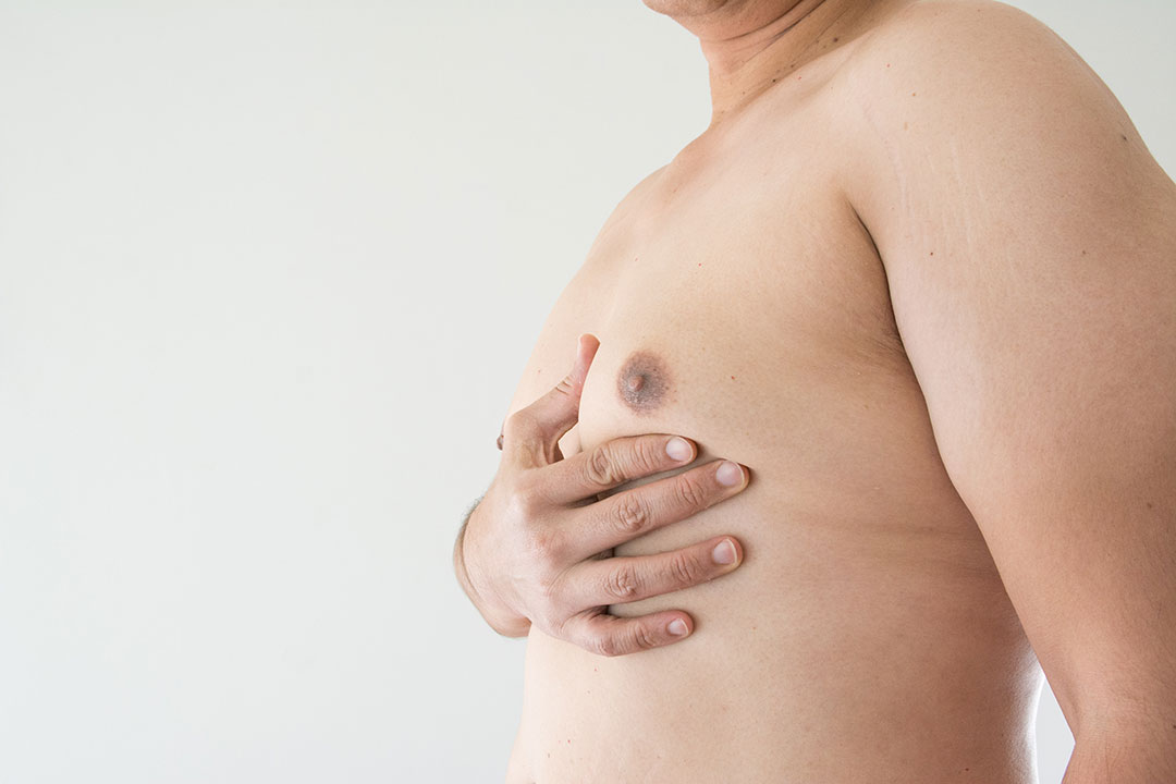 chirurgien gynecomastie montpellier chirurgien gynecomastie montpellier